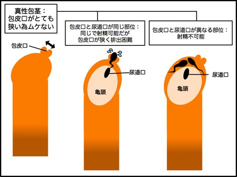 包茎 勃起 画像|真性包茎とは｜上野クリニック.